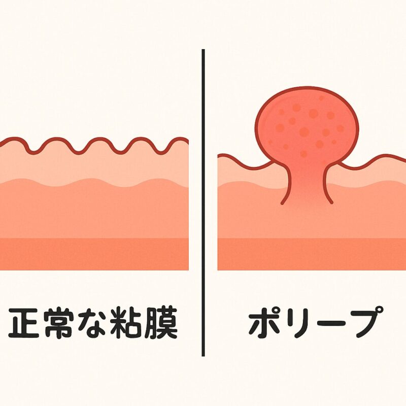ポリープのイメージ