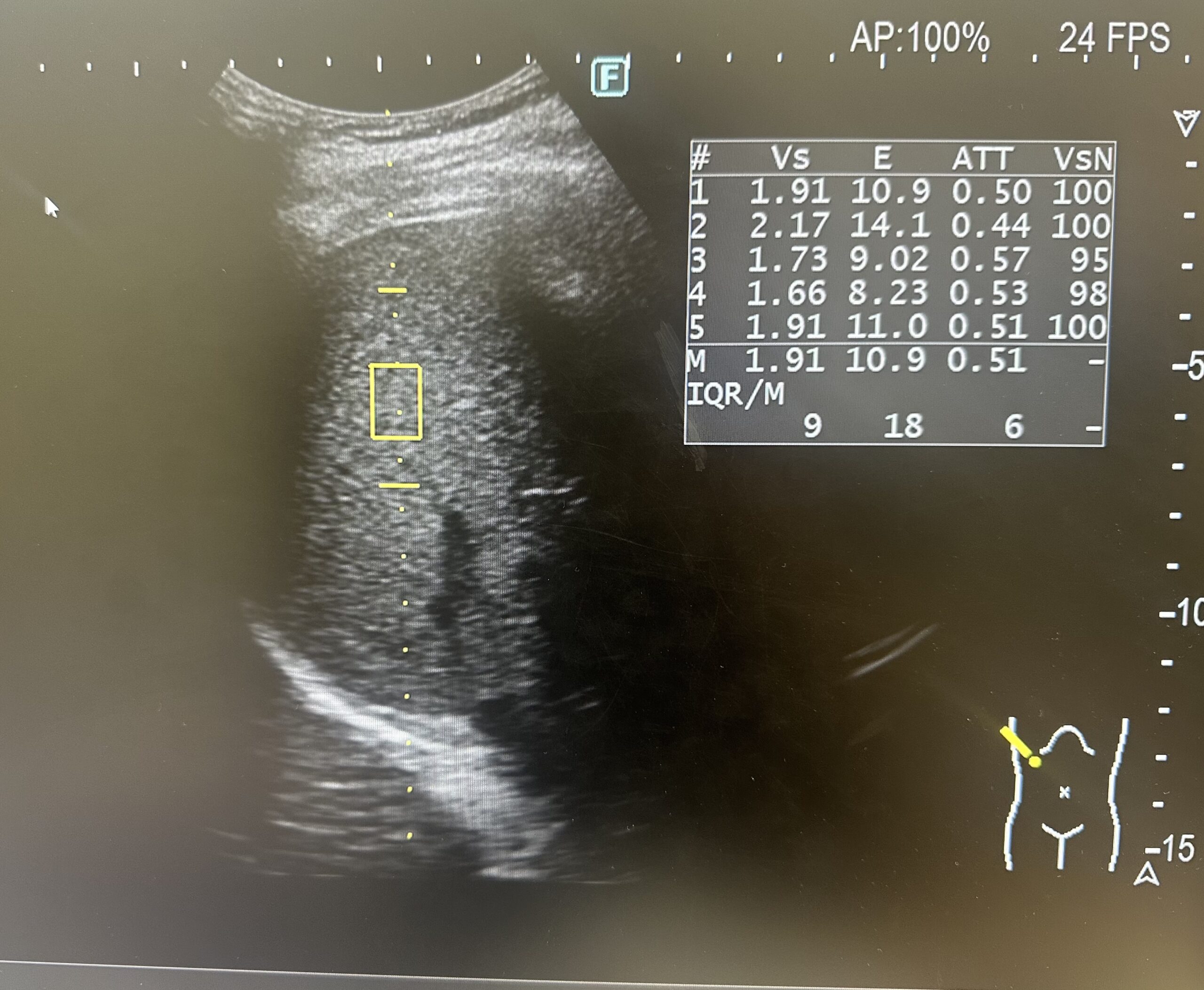 腹部エコー　肝硬度